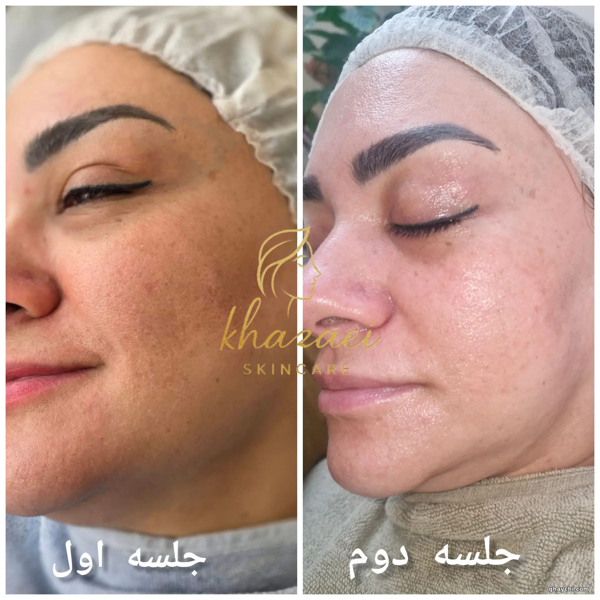 نمونه کار پوست — مراقبت از پوست لک‌دار زنانه در کارون شمالی، تهران — زینب خزایی