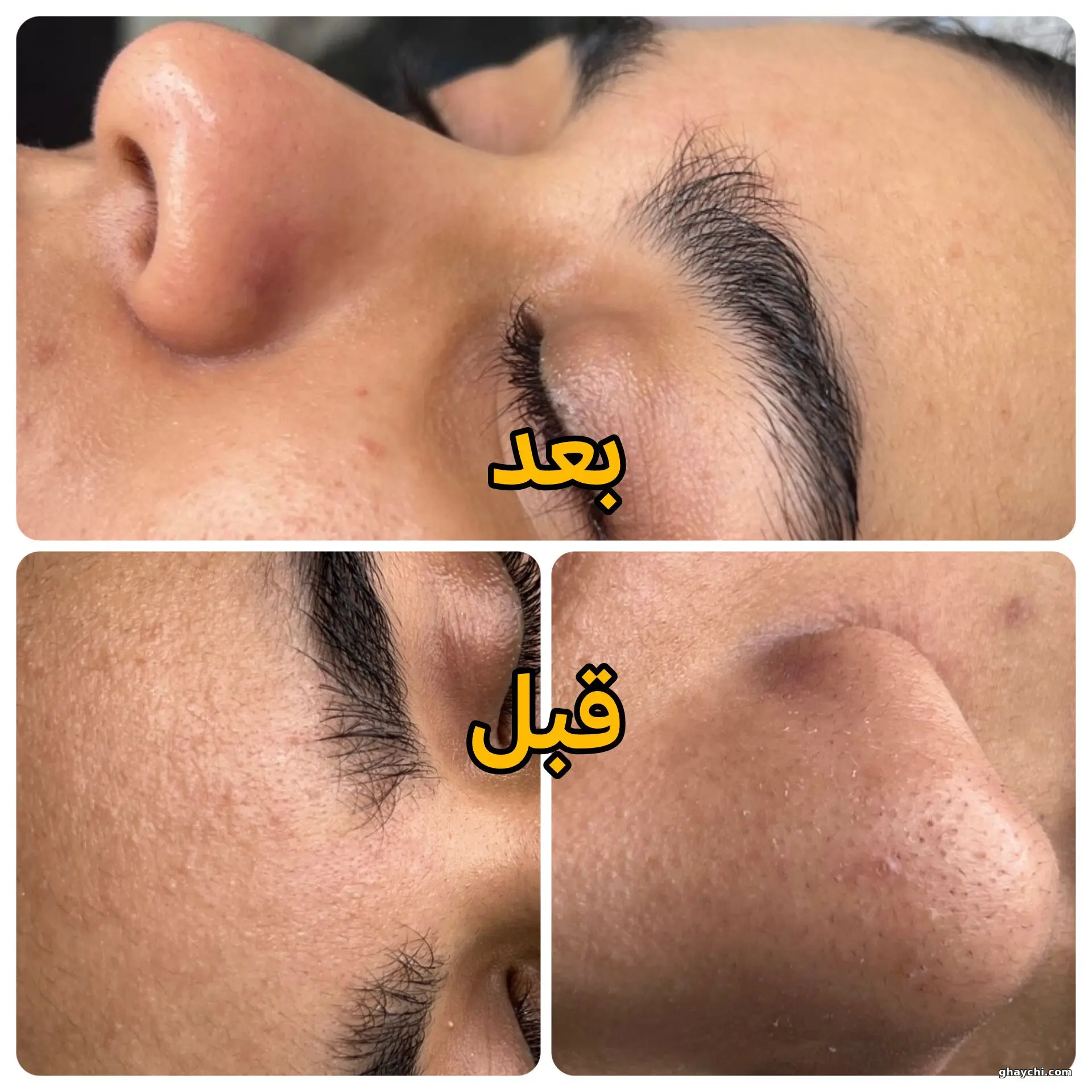 نمونه کار پوست — مزونیدلینگ پوست زنانه در قاسم آباد، مشهد — فاطمه رنجبر