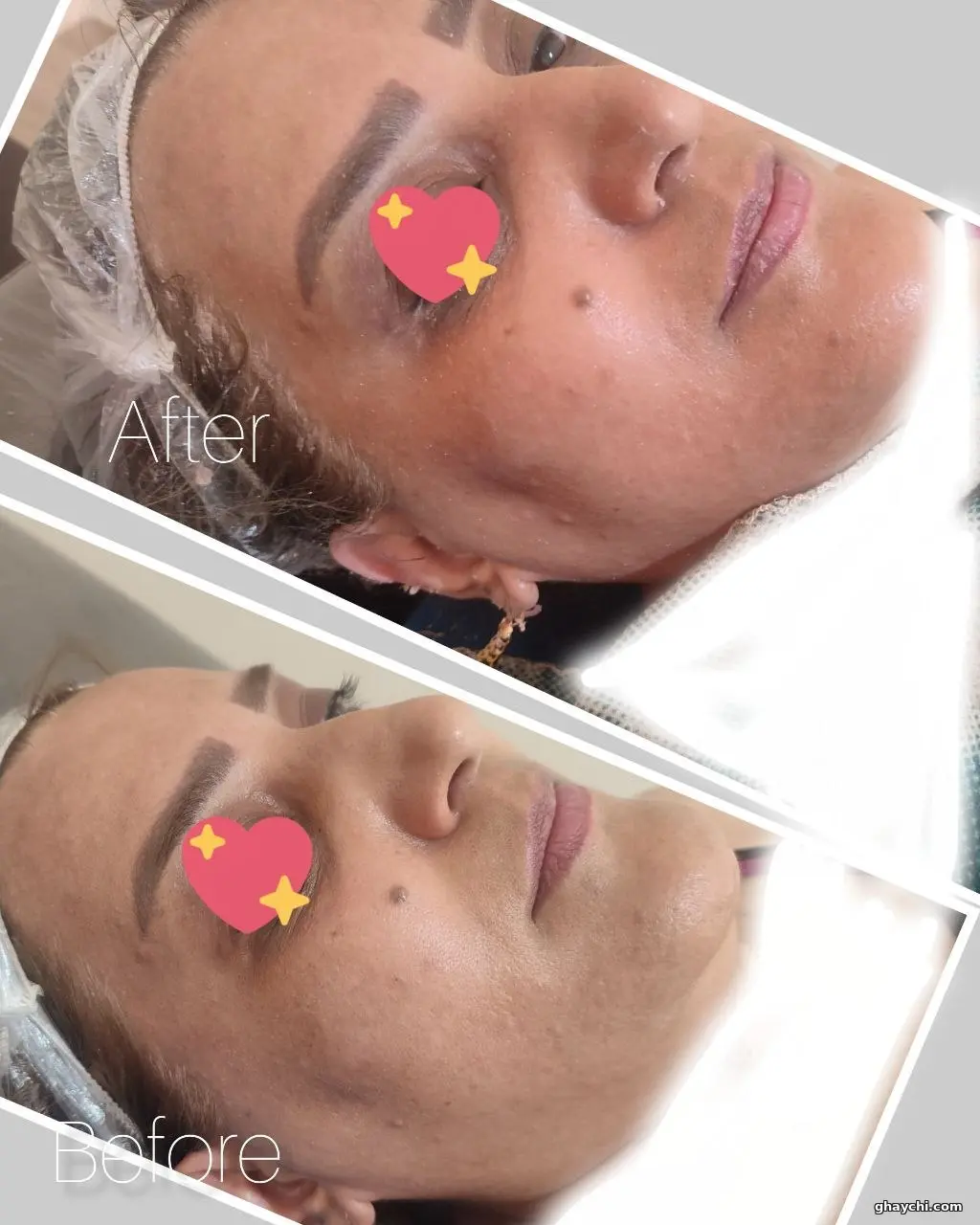 نمونه کار پوست — فیشیال صورت زنانه در آبرسان، تبریز — فاطمه عیوضی