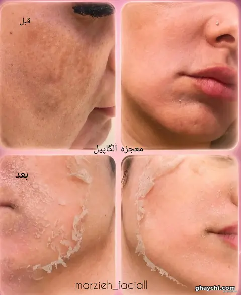 نمونه کار پوست — لایه برداری زنانه در  بلوار سفیر، شیراز — مرضیه حیاتی