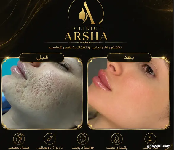 نمونه کار پوست — فیشیال صورت زنانه در سنندج، سنندج — کلینیک تخصصی پوست وموواسپا آرشا