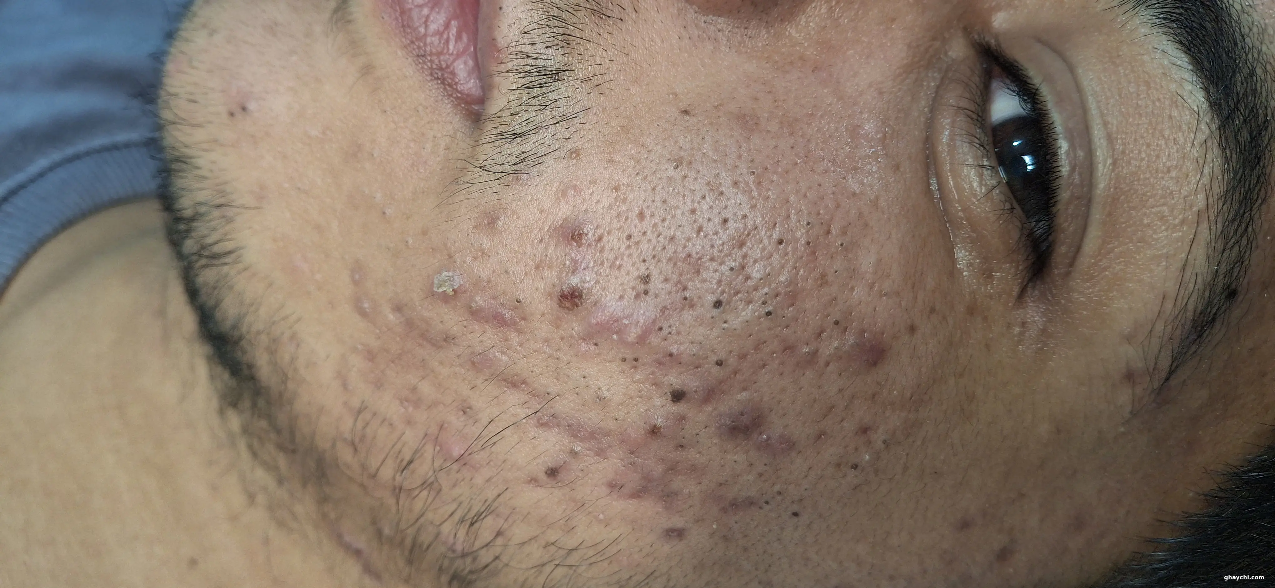 قبل پوست — فیشیال صورت در اسلامشهر، اسلامشهر — کلینیک گل نرگس