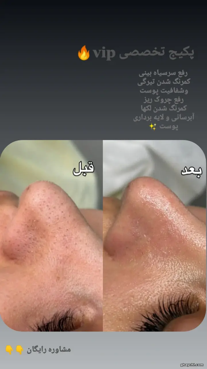 نمونه کار پوست — کلاژن سازی زنانه در رشت، رشت — سکینه رجبی مقدم