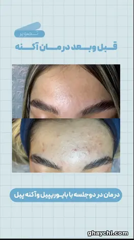 نمونه کار پوست — فیشیال صورت زنانه در سنندج، سنندج — کلینیک تخصصی پوست وموواسپا آرشا
