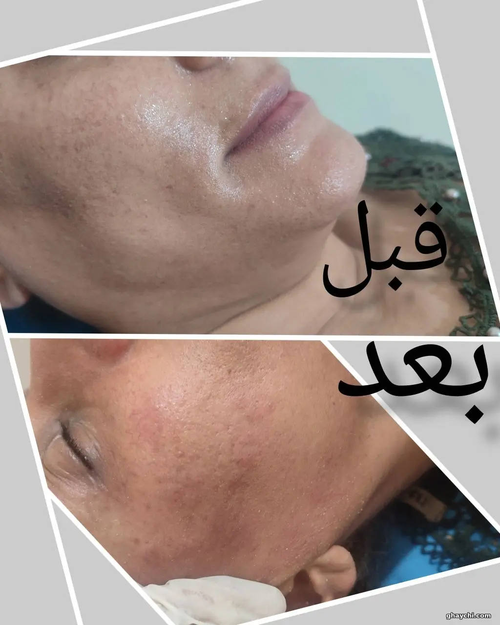 نمونه کار پوست — فیشیال صورت زنانه در آبرسان، تبریز — فاطمه عیوضی