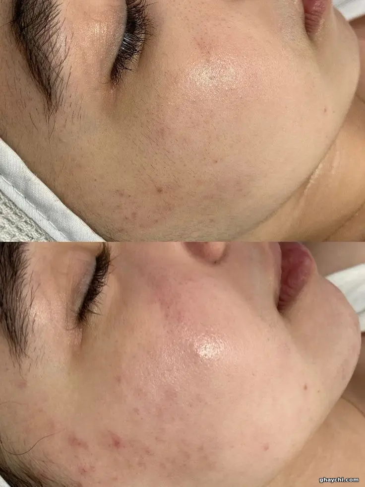 نمونه کار پوست — فیشیال صورت زنانه در  بلوار معالی آباد، شیراز — فرزانه جعفری