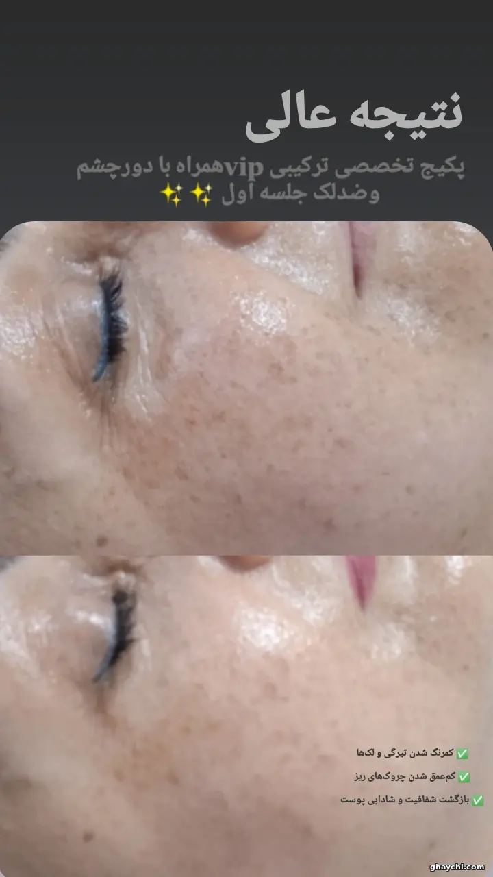 قبل پوست — فیشیال دور چشم در رشت، رشت — سکینه رجبی مقدم