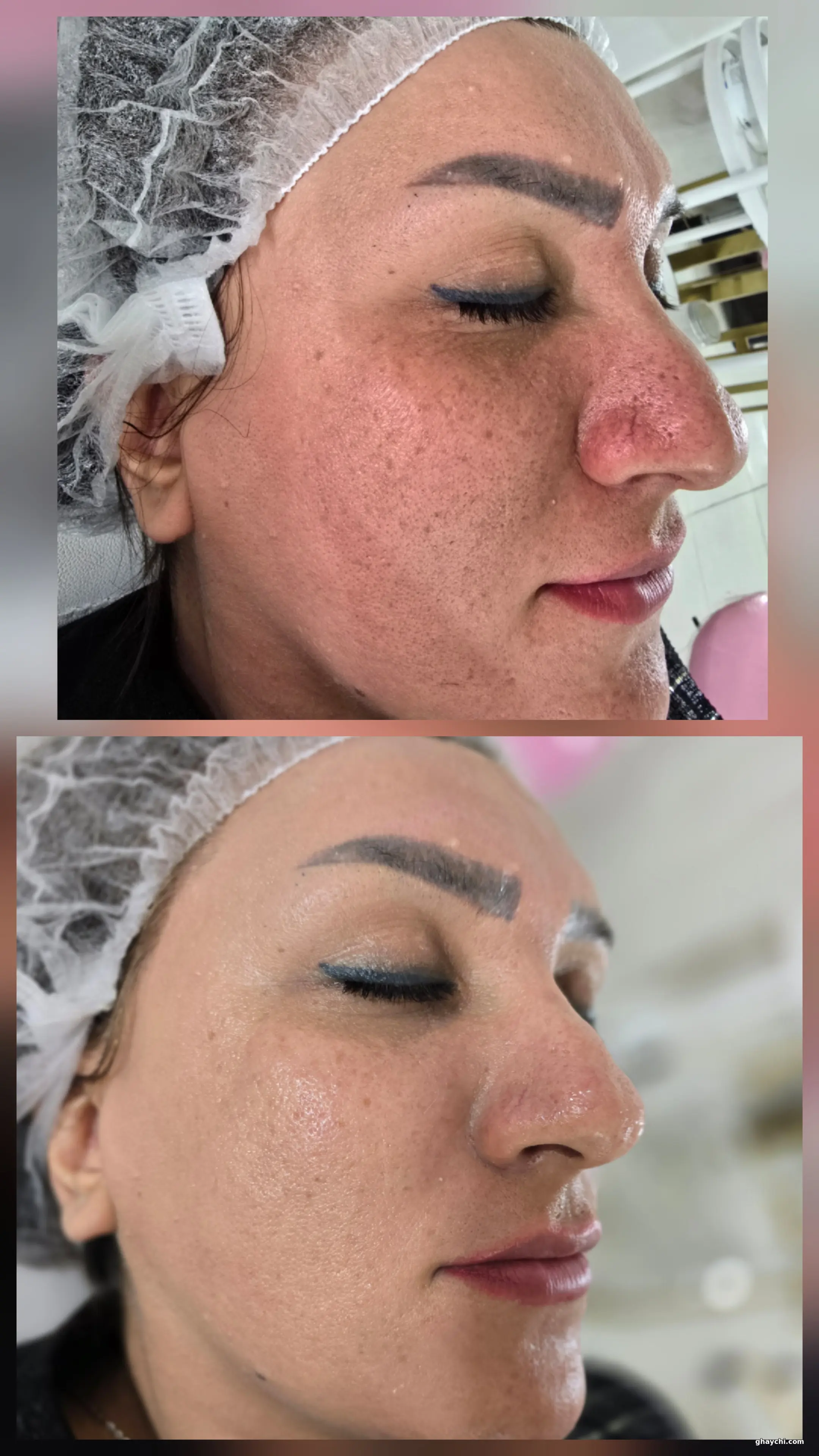 نمونه کار پوست — مراقبت از پوست لک‌دار زنانه در زنجان، زنجان — الهام شجاعی
