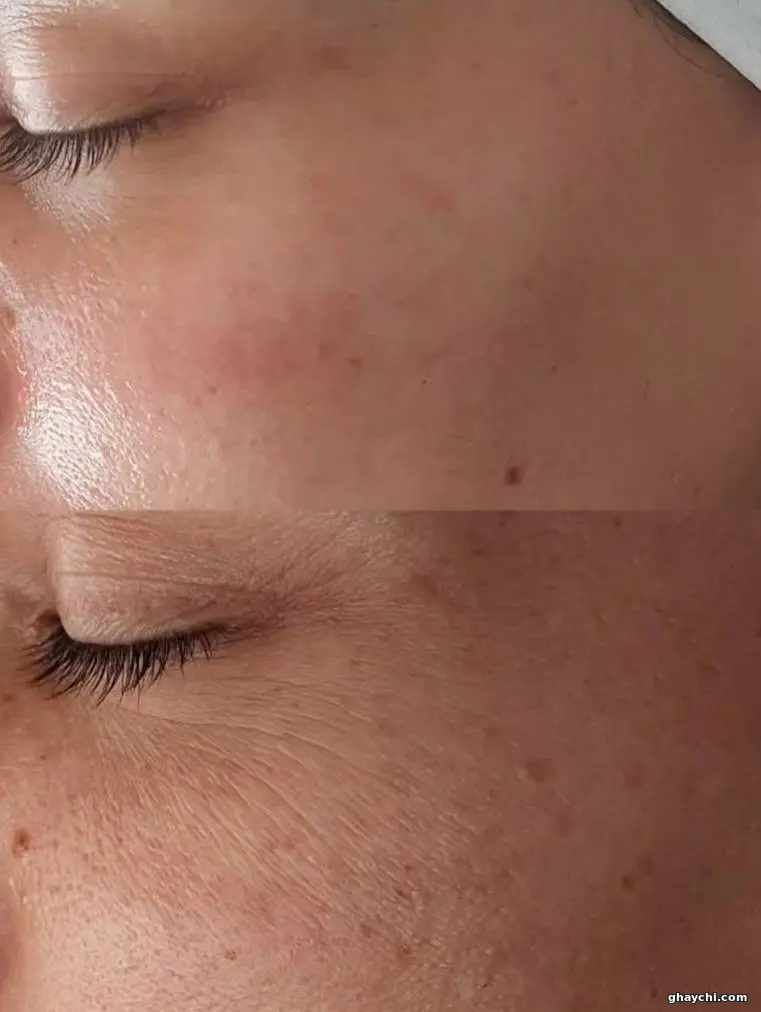 قبل پوست — پاکسازی صورت در مشکین دشت، فردیس — سالن زیبایی بهار