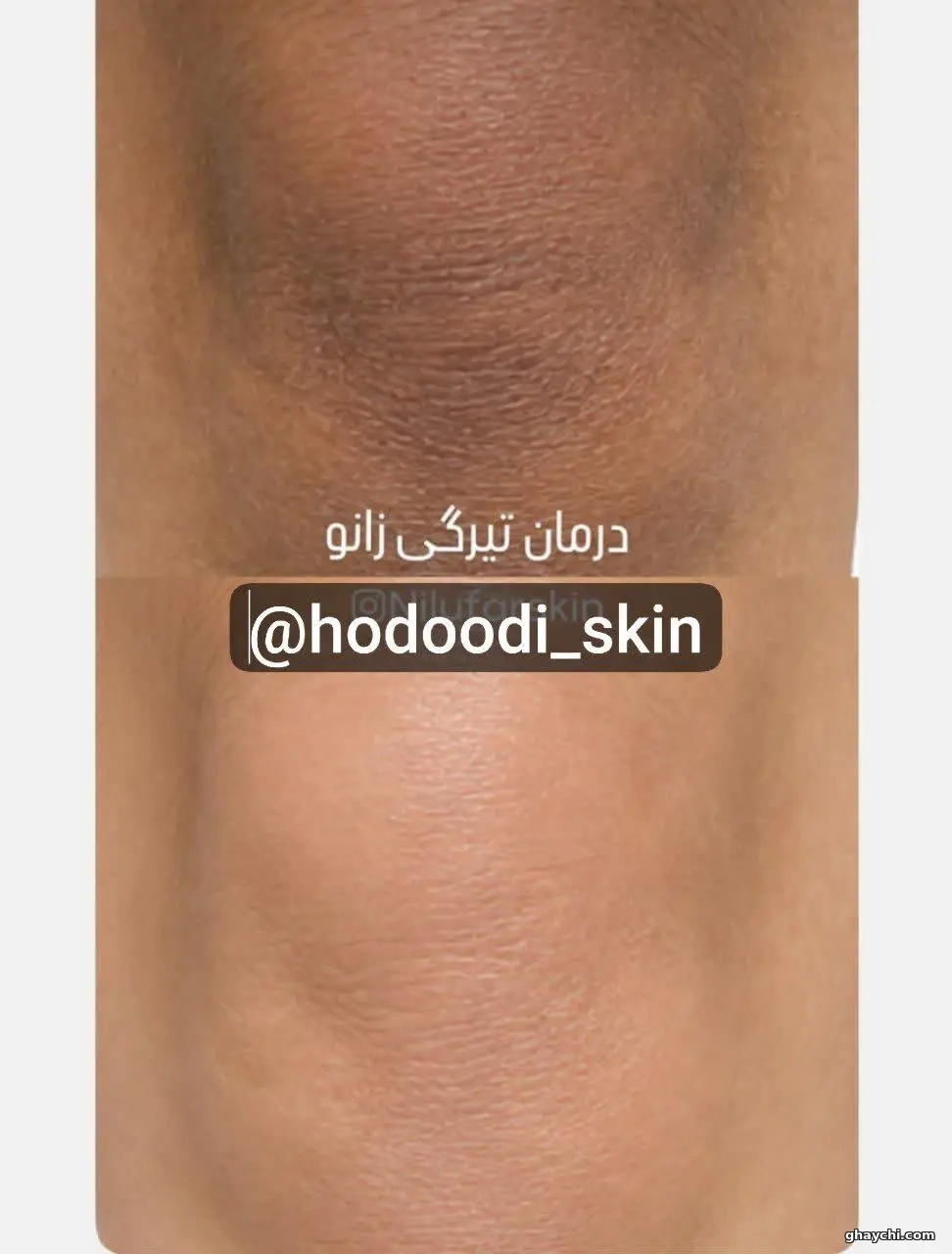 نمونه کار پوست — فیشیال صورت زنانه در سنندج، سنندج — کلینیک تخصصی پوست وموواسپا آرشا