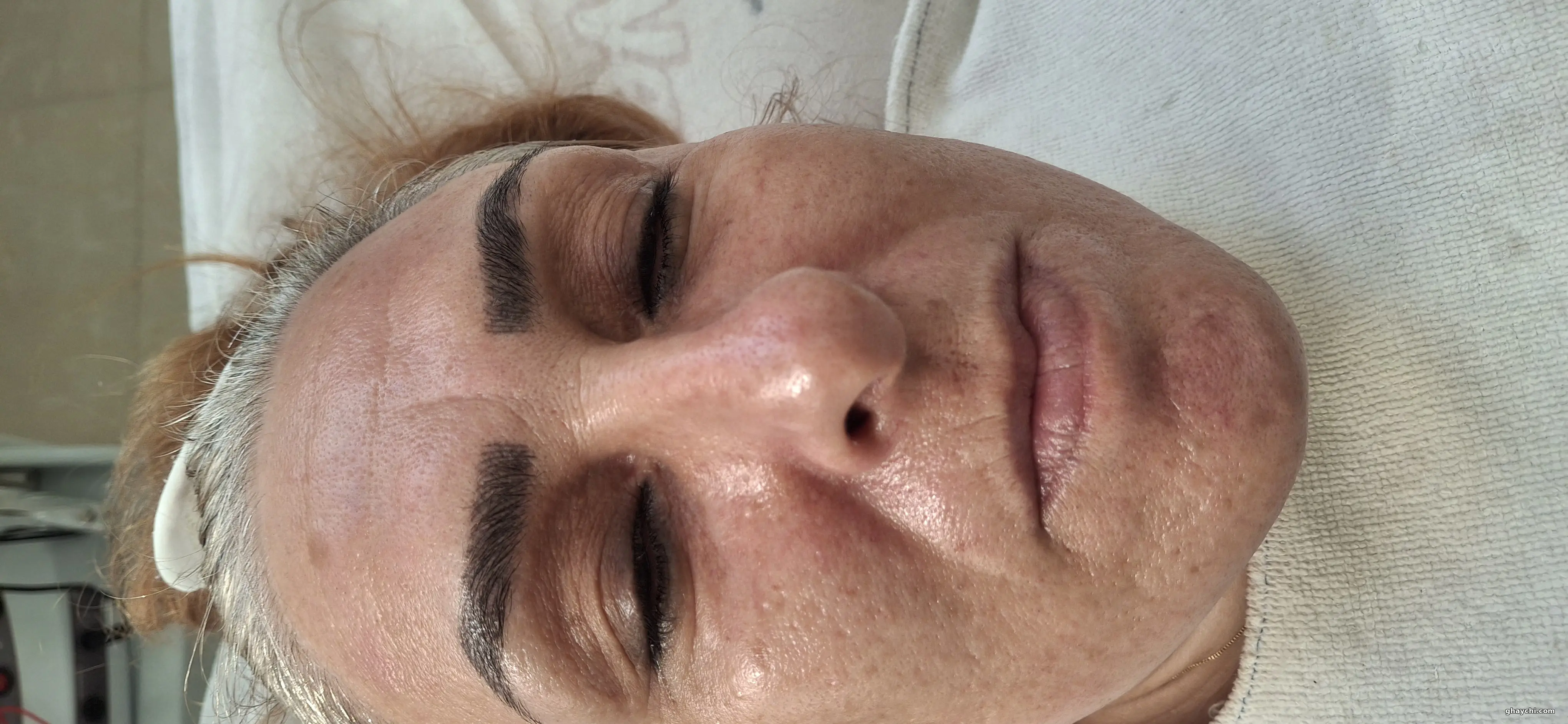 قبل پوست — آبرسانی صورت در اسلامشهر، اسلامشهر — کلینیک گل نرگس