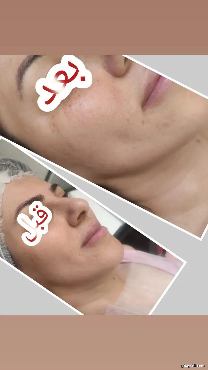 نمونه کار پوست — فیشیال صورت زنانه در آبرسان، تبریز — فاطمه عیوضی