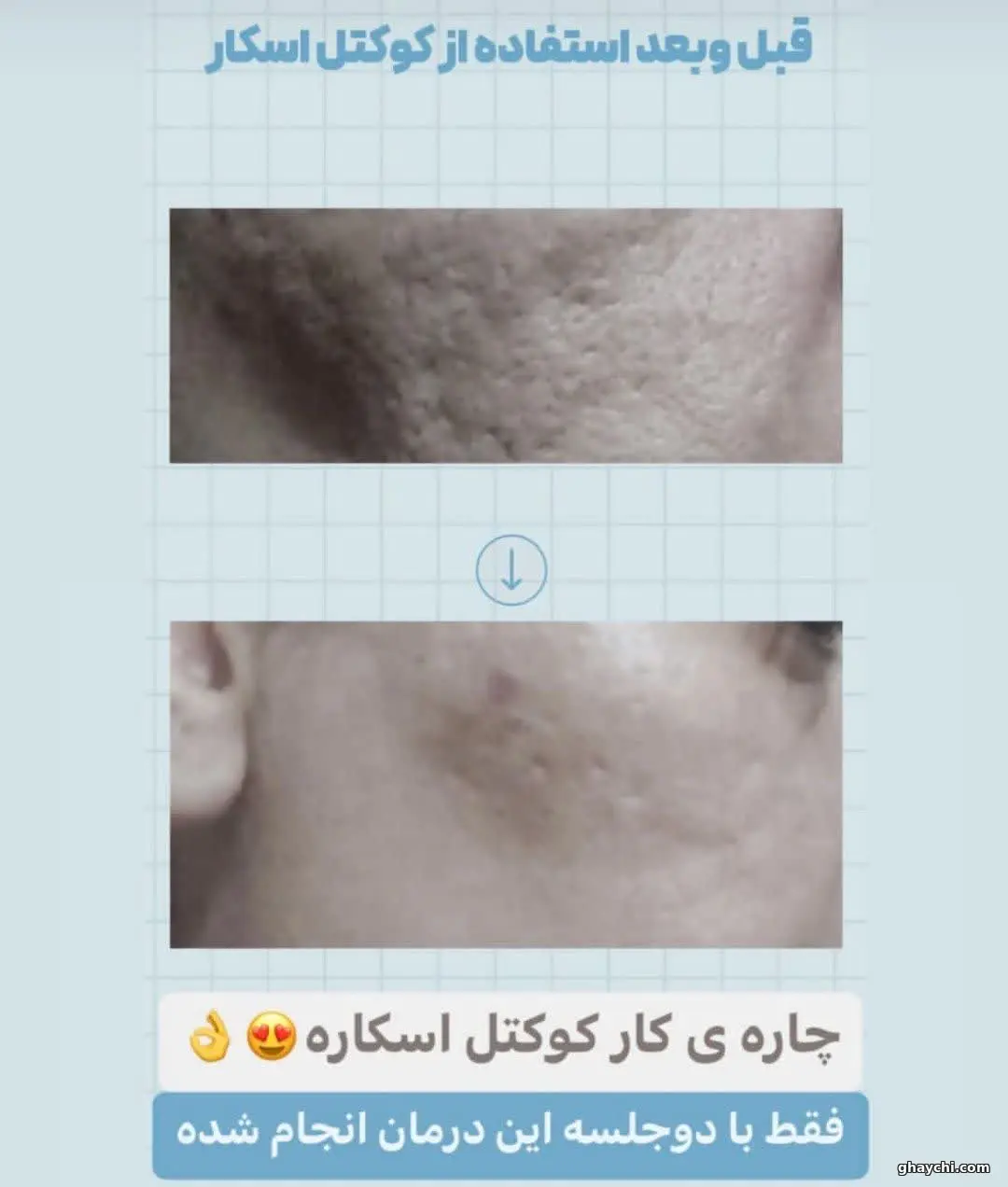 نمونه کار پوست — فیشیال صورت زنانه در سنندج، سنندج — کلینیک تخصصی پوست وموواسپا آرشا
