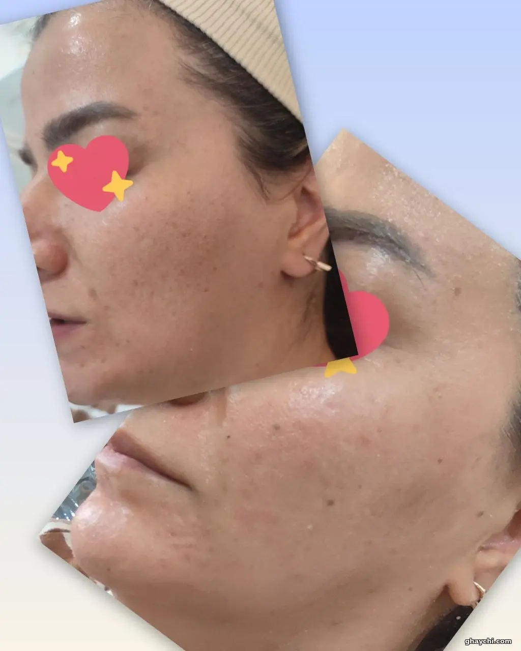 نمونه کار پوست — فیشیال صورت زنانه در آبرسان، تبریز — فاطمه عیوضی
