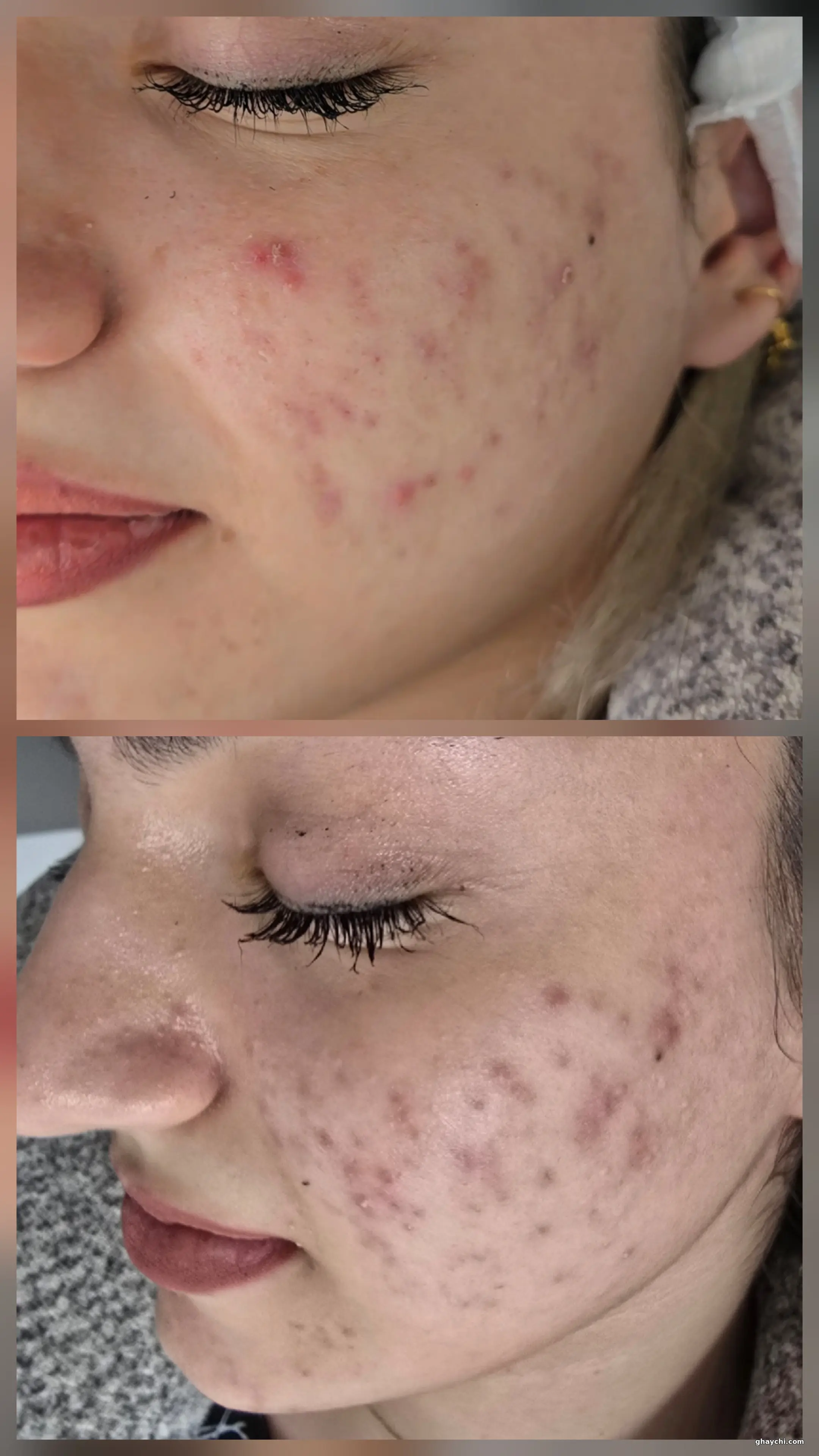 نمونه کار پوست — فیشیال صورت زنانه در زنجان، زنجان — الهام شجاعی