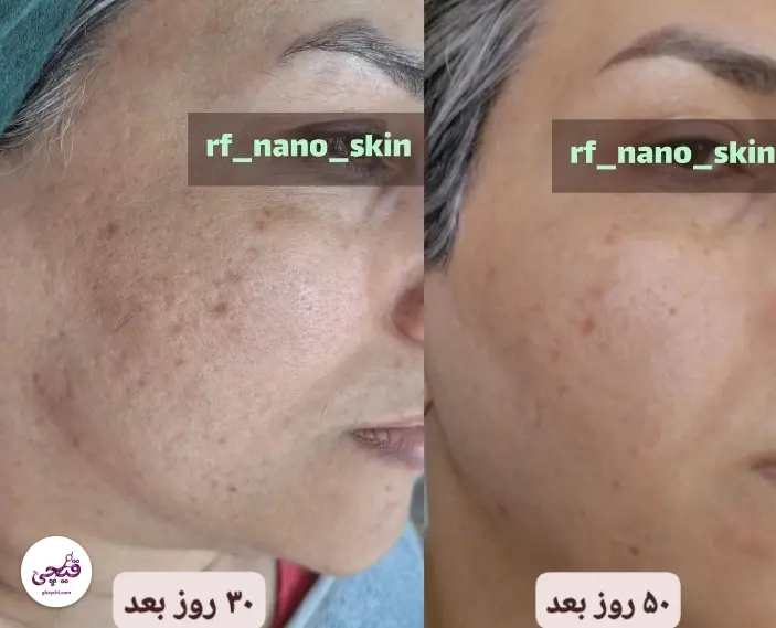 نمونه کار پوست — مراقبت از پوست لک‌دار زنانه در کرمان، کرمان — الی مومنی