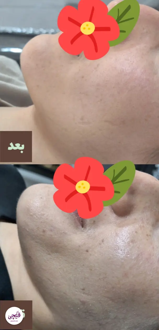 نمونه کار پوست — مراقبت از پوست لک‌دار زنانه در کرمان، کرمان — الی مومنی