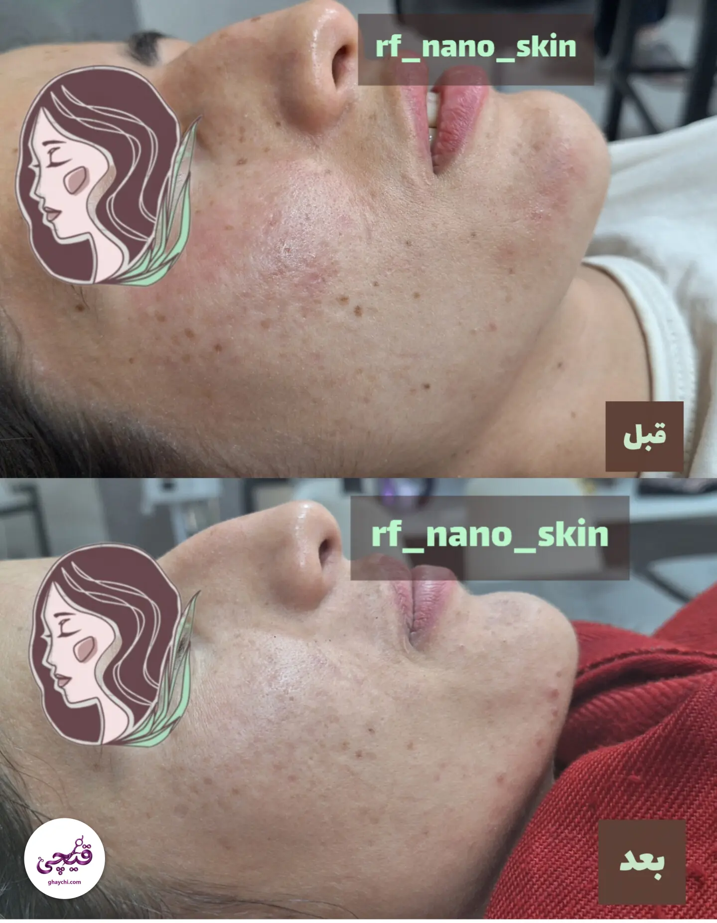 نمونه کار پوست — مراقبت از پوست لک‌دار زنانه در کرمان، کرمان — الی مومنی