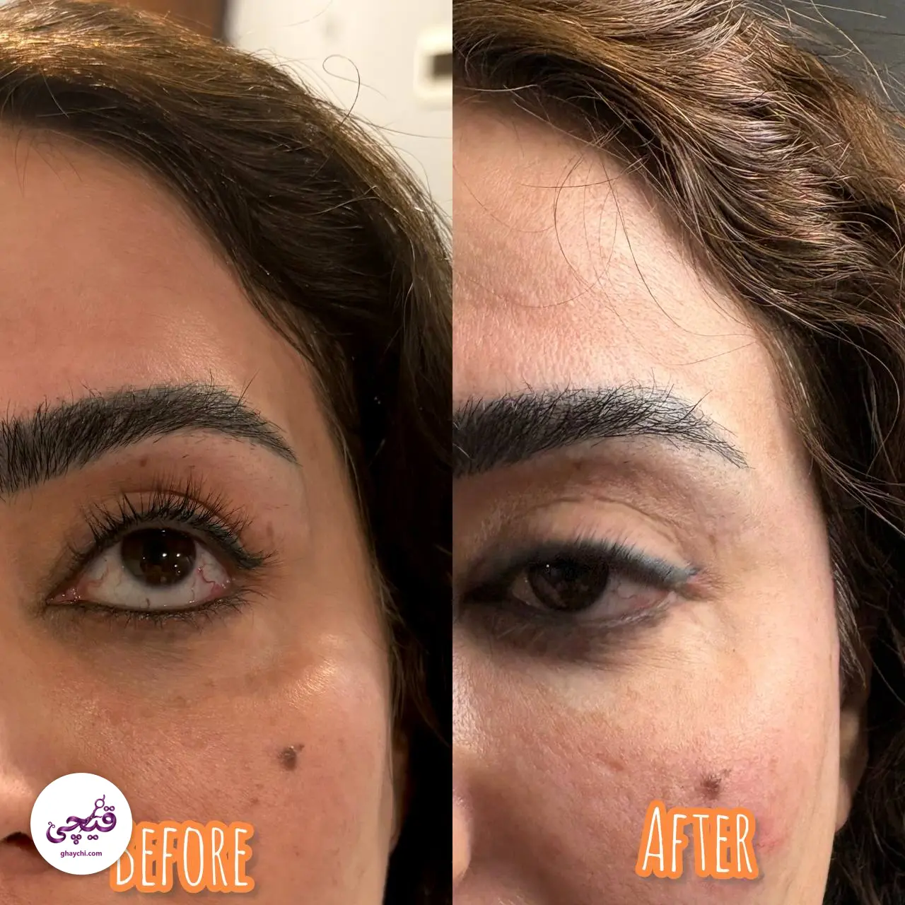 نمونه کار پوست — کلاژن سازی زنانه در هشتگرد، هشتگرد — مطب زیبایی